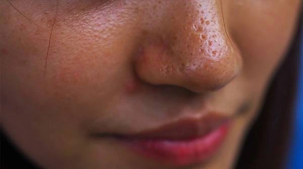 Best Skincare Routine for Oily Skin